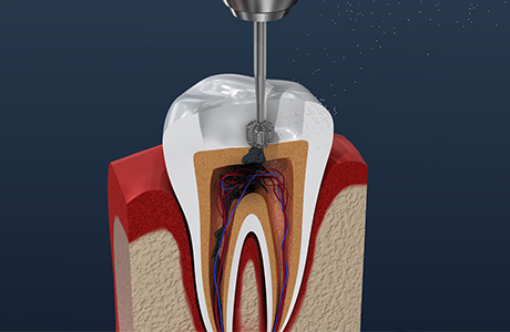 天然の歯を残すための根管治療