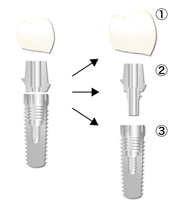 インプラント構造図