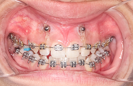 歯を効率よく動かせるインプラント矯正