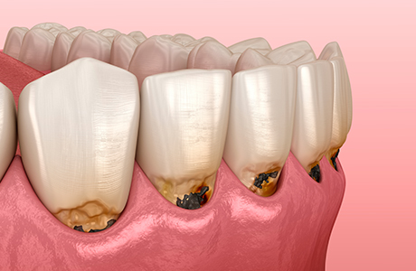 気づかないうちに進行する歯周病