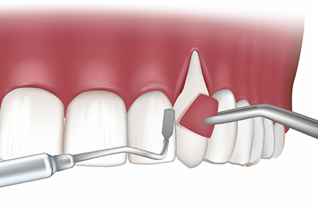 進行した歯周病に行う外科治療・再生療法