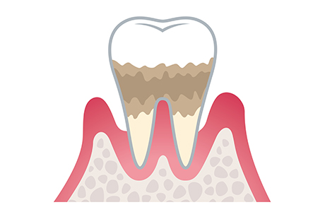失われた歯周組織の回復を目指す治療