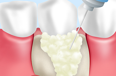 エムドゲイン療法による歯周病治療