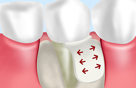 GTR法による歯周病治療