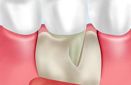 骨移植による歯周病治療