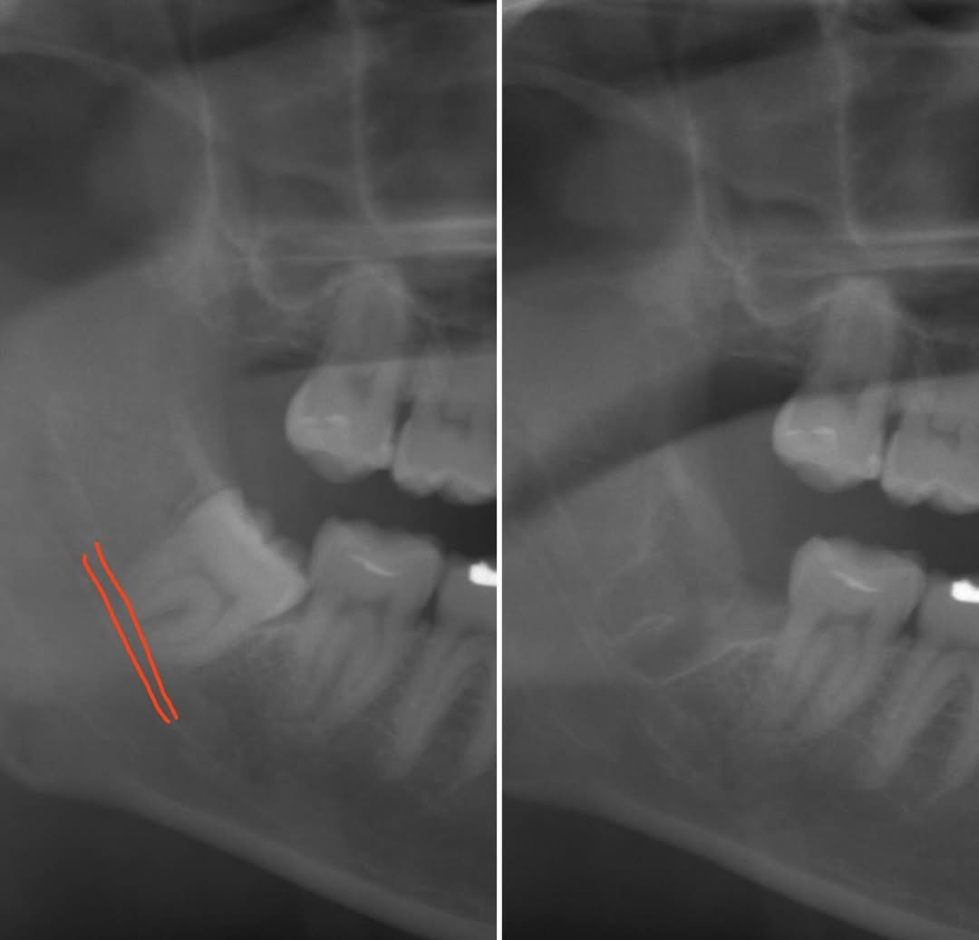 親知らず抜歯（難抜歯症例）